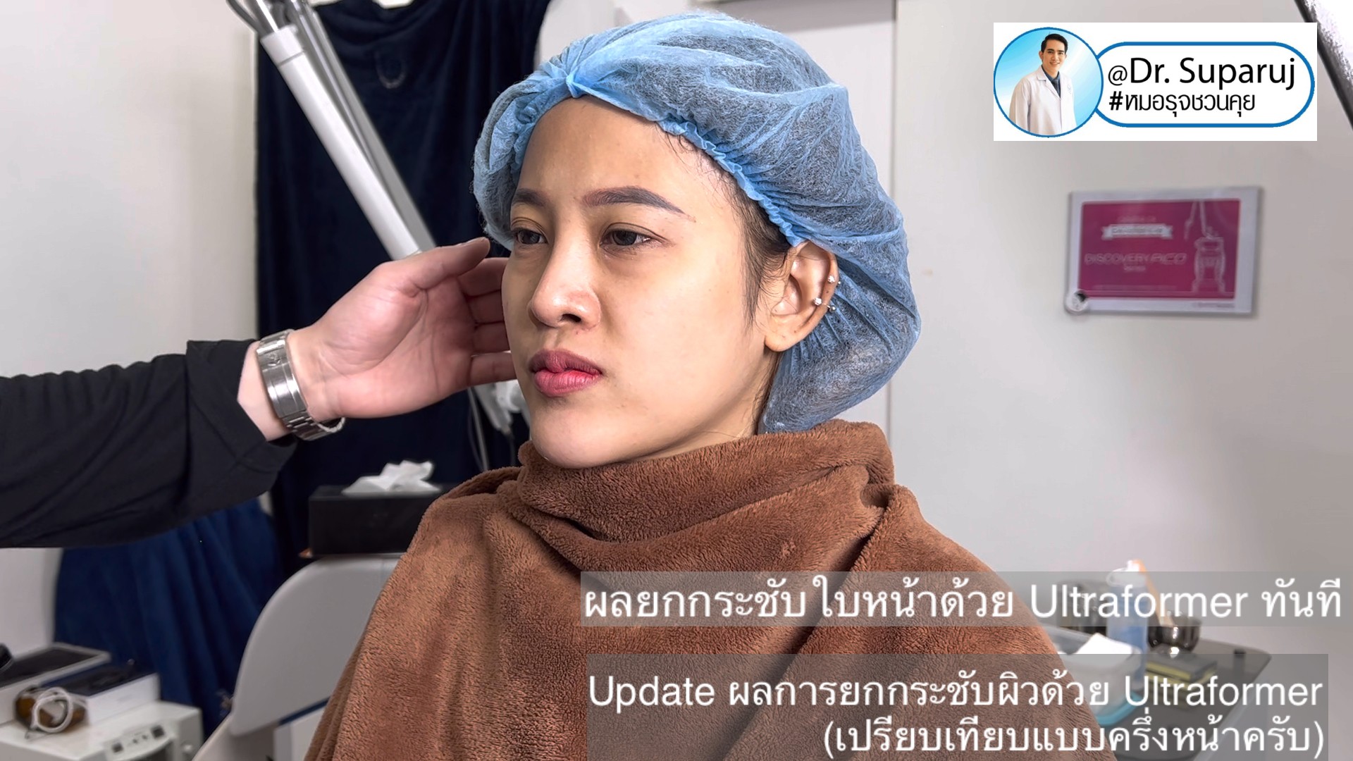 Update ผลการยกกระชับผิวด้วย Ultraformer III (เปรียบเทียบแบบครึ่งหน้าให้เห็นชัดๆครับ) Update ผลการยกกระชับผิวด้วย Ultraformer III (เปรียบเทียบแบบครึ่งหน้าให้เห็นชัดๆครับ)