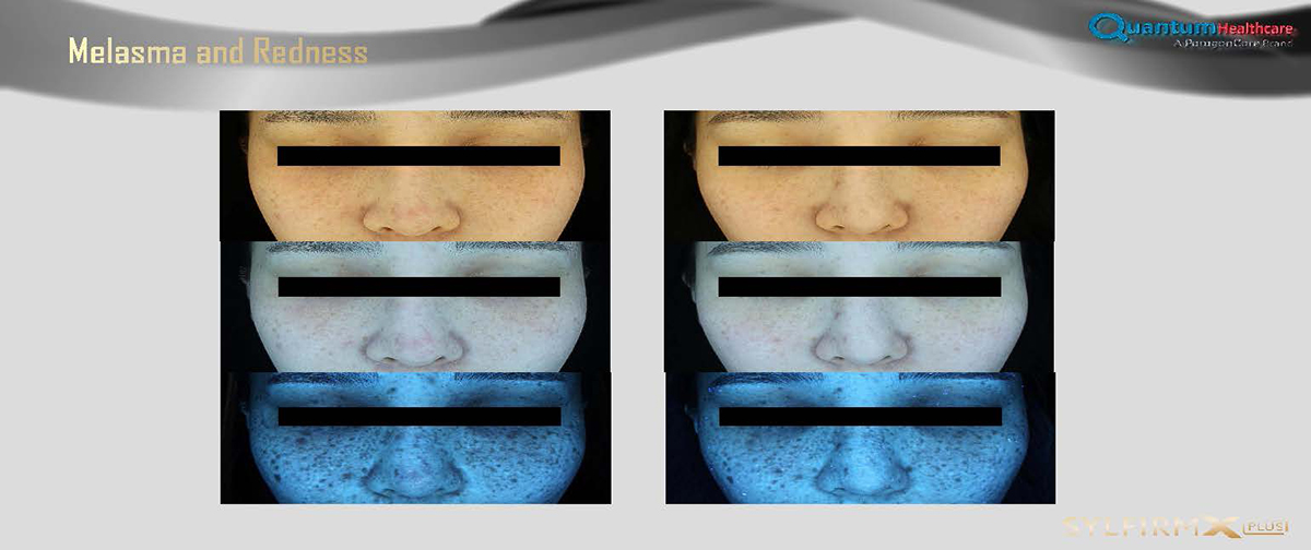 เทคนิครักษาหลุมสิวด้วย SYLFIRM X Plus Fractional RF Microneedle: มีลักษณะพลังงานพิเศษ Pulsed Wave PW Mode + Continous Wave CW Mode เทคนิครักษาหลุมสิวด้วย SYLFIRM X Plus Fractional RF Microneedle: มีลักษณะพลังงานพิเศษ Pulsed Wave PW Mode + Continous Wave CW Mode