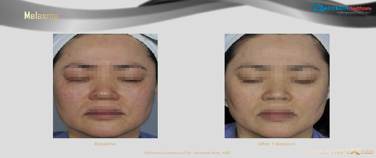 เทคนิครักษาหลุมสิวด้วย SYLFIRM X Plus Fractional RF Microneedle: มีลักษณะพลังงานพิเศษ Pulsed Wave PW Mode + Continous Wave CW Mode เทคนิครักษาหลุมสิวด้วย SYLFIRM X Plus Fractional RF Microneedle: มีลักษณะพลังงานพิเศษ Pulsed Wave PW Mode + Continous Wave CW Mode