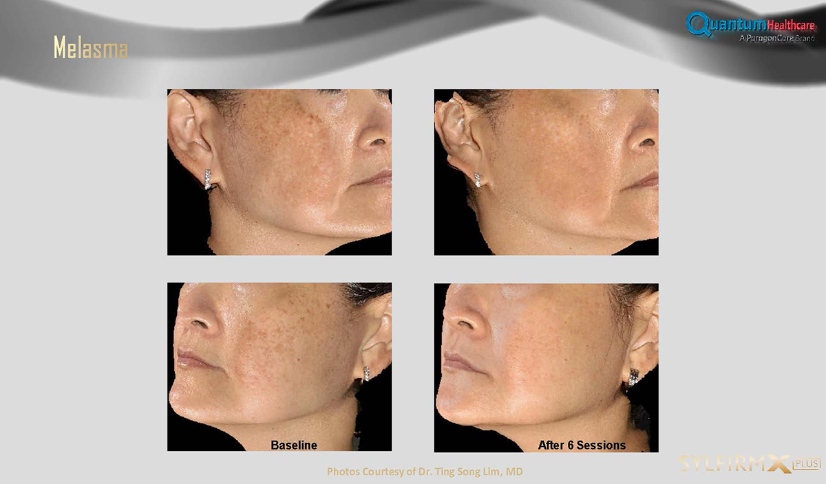 เทคนิครักษาหลุมสิวด้วย SYLFIRM X Plus Fractional RF Microneedle: มีลักษณะพลังงานพิเศษ Pulsed Wave PW Mode + Continous Wave CW Mode เทคนิครักษาหลุมสิวด้วย SYLFIRM X Plus Fractional RF Microneedle: มีลักษณะพลังงานพิเศษ Pulsed Wave PW Mode + Continous Wave CW Mode