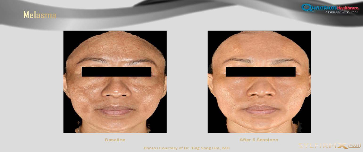 เทคนิครักษาหลุมสิวด้วย SYLFIRM X Plus Fractional RF Microneedle: มีลักษณะพลังงานพิเศษ Pulsed Wave PW Mode + Continous Wave CW Mode เทคนิครักษาหลุมสิวด้วย SYLFIRM X Plus Fractional RF Microneedle: มีลักษณะพลังงานพิเศษ Pulsed Wave PW Mode + Continous Wave CW Mode