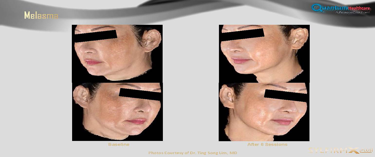 เทคนิครักษาหลุมสิวด้วย SYLFIRM X Plus Fractional RF Microneedle: มีลักษณะพลังงานพิเศษ Pulsed Wave PW Mode + Continous Wave CW Mode เทคนิครักษาหลุมสิวด้วย SYLFIRM X Plus Fractional RF Microneedle: มีลักษณะพลังงานพิเศษ Pulsed Wave PW Mode + Continous Wave CW Mode