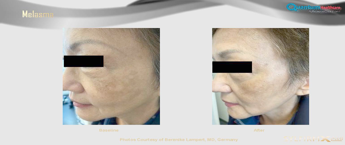 เทคนิครักษาหลุมสิวด้วย SYLFIRM X Plus Fractional RF Microneedle: มีลักษณะพลังงานพิเศษ Pulsed Wave PW Mode + Continous Wave CW Mode เทคนิครักษาหลุมสิวด้วย SYLFIRM X Plus Fractional RF Microneedle: มีลักษณะพลังงานพิเศษ Pulsed Wave PW Mode + Continous Wave CW Mode