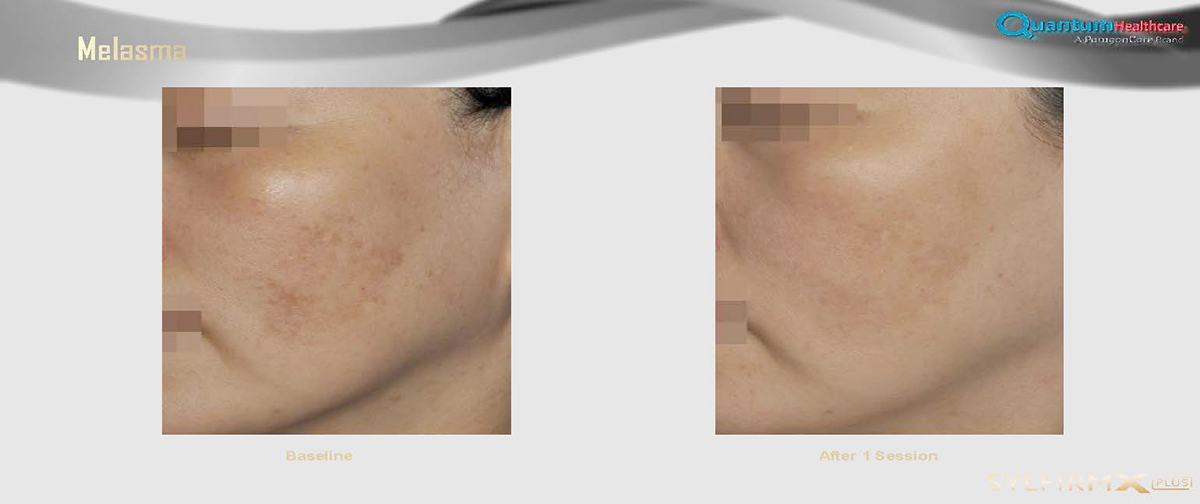 เทคนิครักษาหลุมสิวด้วย SYLFIRM X Plus Fractional RF Microneedle: มีลักษณะพลังงานพิเศษ Pulsed Wave PW Mode + Continous Wave CW Mode เทคนิครักษาหลุมสิวด้วย SYLFIRM X Plus Fractional RF Microneedle: มีลักษณะพลังงานพิเศษ Pulsed Wave PW Mode + Continous Wave CW Mode