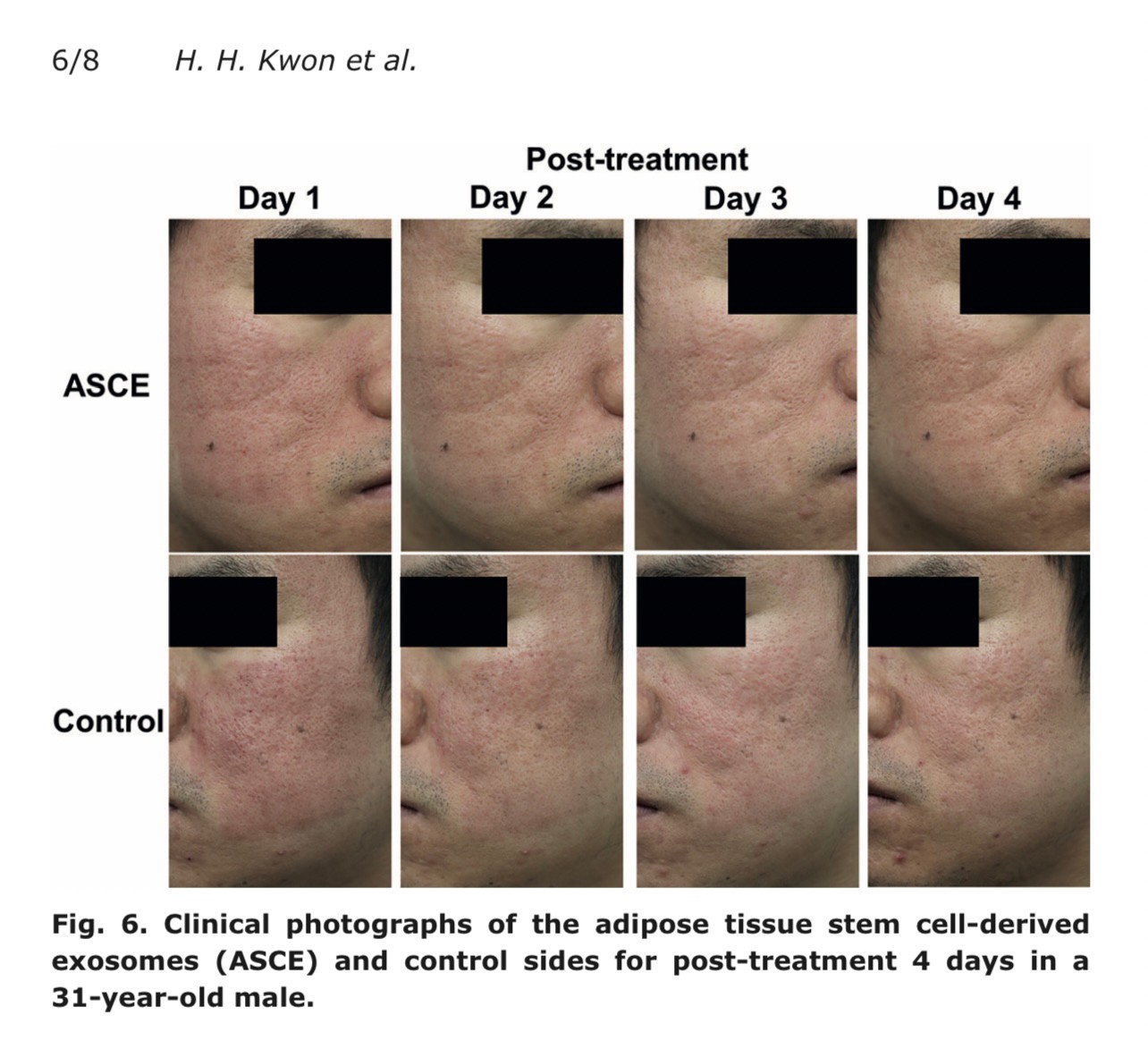 แนะนำเทคนิคในการดูแลหลุมสิว: Exosome ใน การรักษาหลุมสิว (Exosome & acne scar treatment)