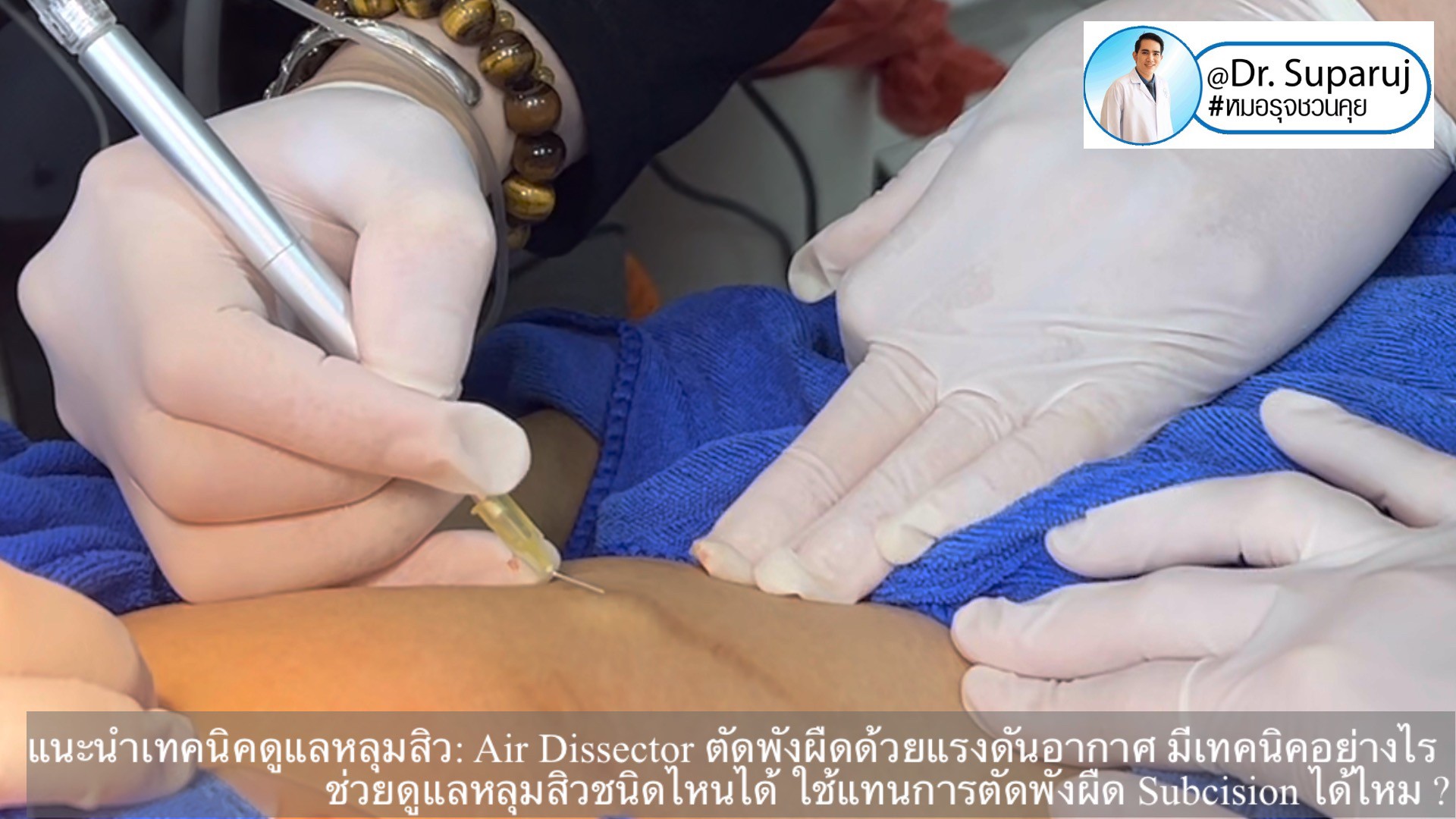 แนะนำเทคนิคดูแลหลุมสิว: Air Dissector ตัดพังผืดด้วยแรงดันอากาศ มีเทคนิคอย่างไร ช่วยดูแลหลุมสิวชนิดไหนได้ ใช้แทนการตัดพังผืด Subcision ได้ไหม ? แนะนำเทคนิคดูแลหลุมสิว: Air Dissector ตัดพังผืดด้วยแรงดันอากาศ มีเทคนิคอย่างไร ช่วยดูแลหลุมสิวชนิดไหนได้ ใช้แทนการตัดพังผืด Subcision ได้ไหม ?