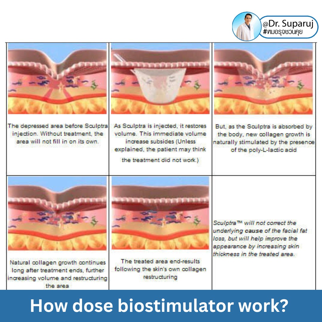 Update เทคนิคกระตุ้นการสร้างคอลลาเจนในผิวหนังลดเลือนริ้วรอย: Collagen Biostimulator Update เทคนิคกระตุ้นการสร้างคอลลาเจนในผิวหนังลดเลือนริ้วรอย: Collagen Biostimulator