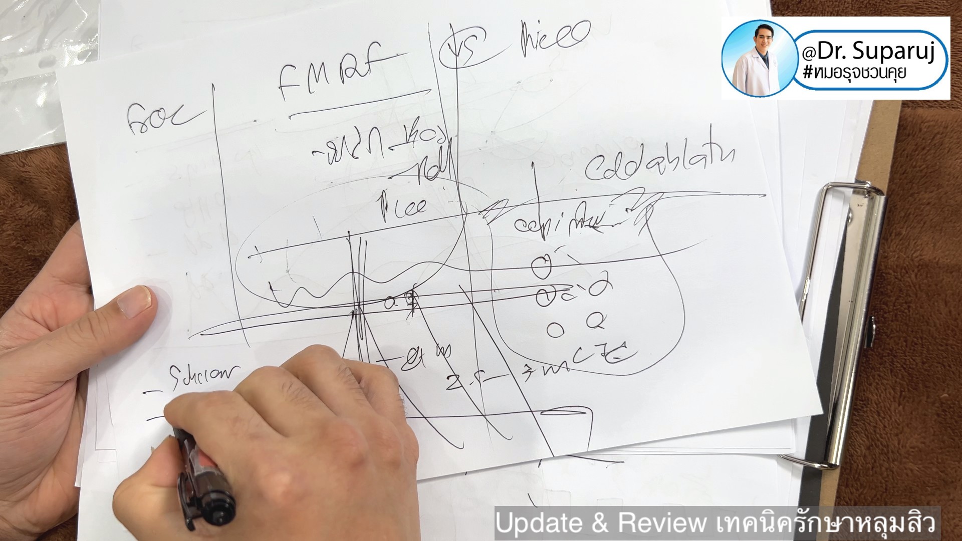 Update & Review เทคนิครักษาหลุมสิว (Acne Scar Treatment: Update & Review) Update & Review เทคนิครักษาหลุมสิว (Acne Scar Treatment: Update & Review)