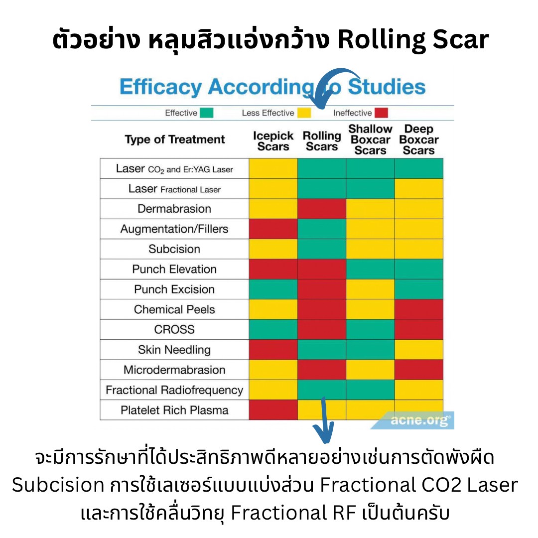 เป็นหลุมสิว แต่ยังไม่พร้อมรักษาหลุมสิว ทำอย่างไรดี? (+ เทคนิคการ เลือกใช้วิธีรักษาลุมสิวเบื้องต้นครับ)