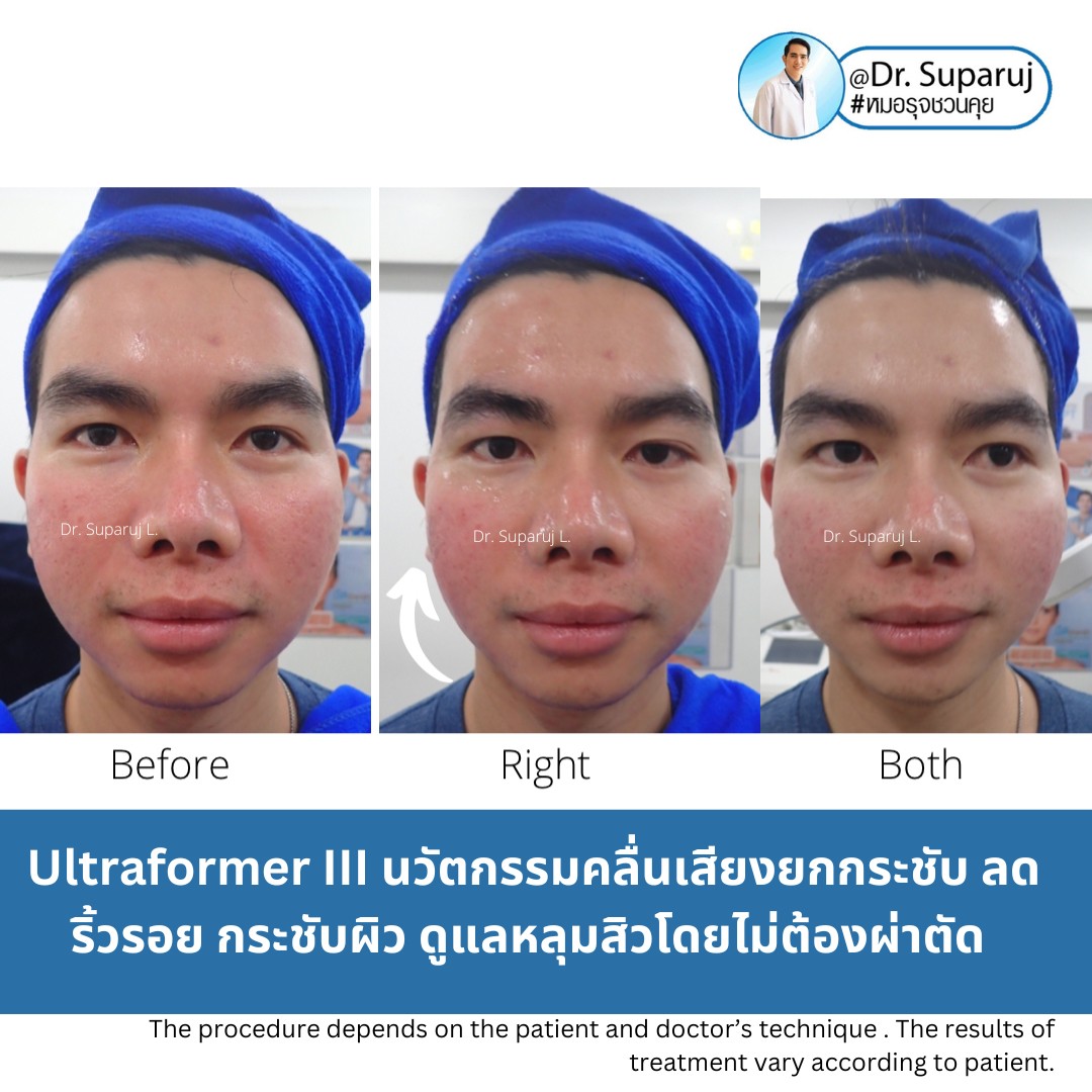 เทคโนโลยียกกระชับผิว MMFU : Micro &Macro Focused Ultrasound ของ Ultraformer III ทำงานอย่างไร ทำไมถึงดีกว่า HIFU ? เทคโนโลยียกกระชับผิว MMFU : Micro &Macro Focused Ultrasound ของ Ultraformer III ทำงานอย่างไร ทำไมถึงดีกว่า HIFU ?