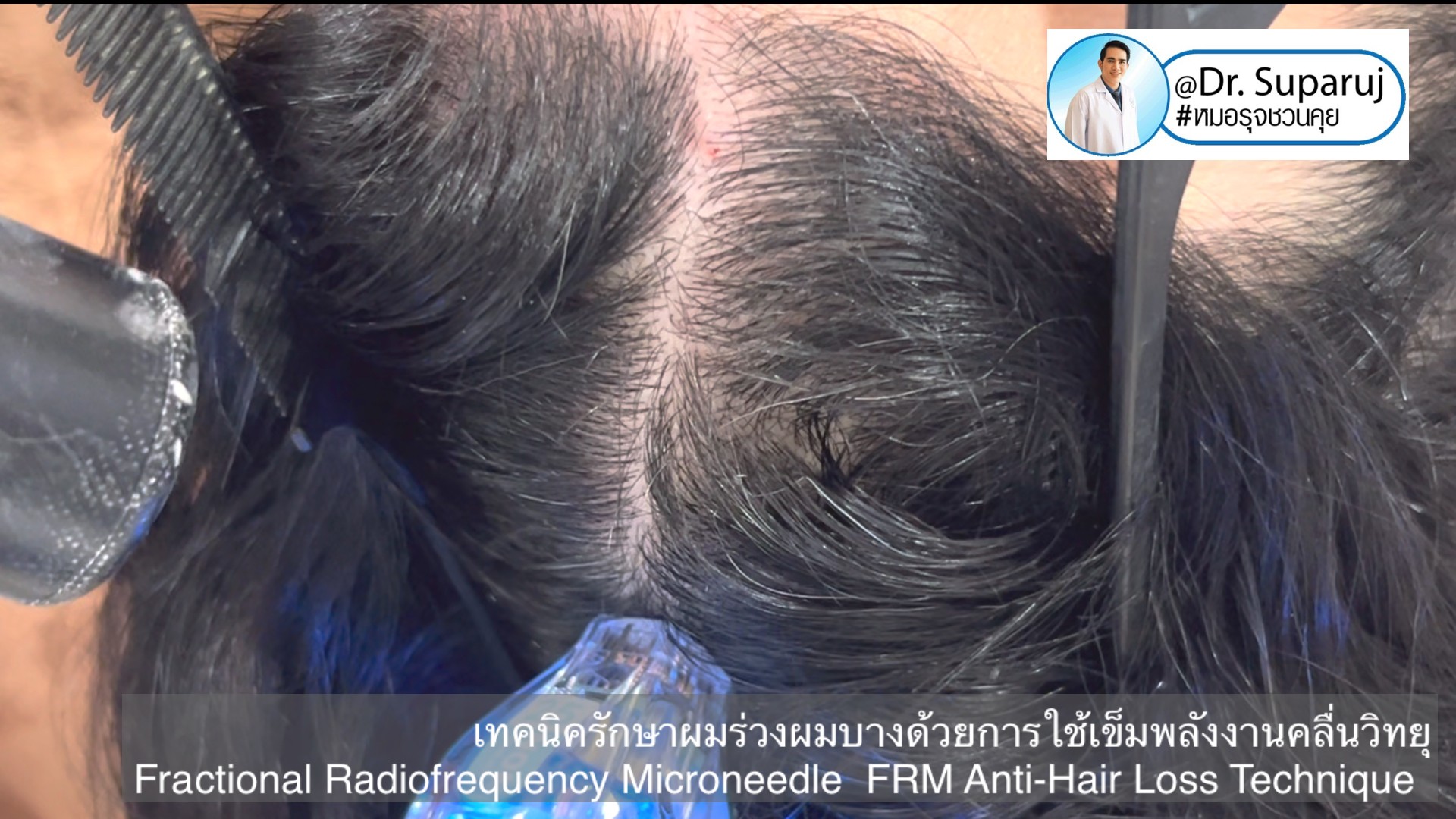 แนะนำเทคนิครักษาผมร่วงผมบาง: เทคนิครักษาผมร่วงผมบางด้วยการใช้เข็มพลังงานคลื่นวิทยุ Fractional Radiofrequency Microneedle FRM Anti-Hair Loss Technique แนะนำเทคนิครักษาผมร่วงผมบาง: เทคนิครักษาผมร่วงผมบางด้วยการใช้เข็มพลังงานคลื่นวิทยุ Fractional Radiofrequency Microneedle FRM Anti-Hair Loss Technique