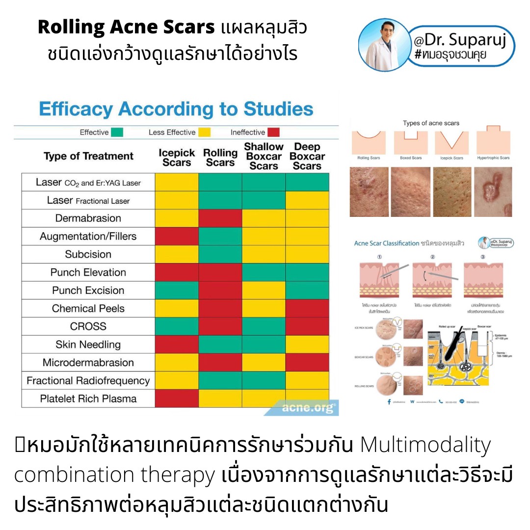 มีสิวอักเสบเม็ดใหญ่ ไม่มีหัว ขึ้น ดูแลอย่างไรดี ? มีสิวอักเสบเม็ดใหญ่ ไม่มีหัว ขึ้น ดูแลอย่างไรดี ?