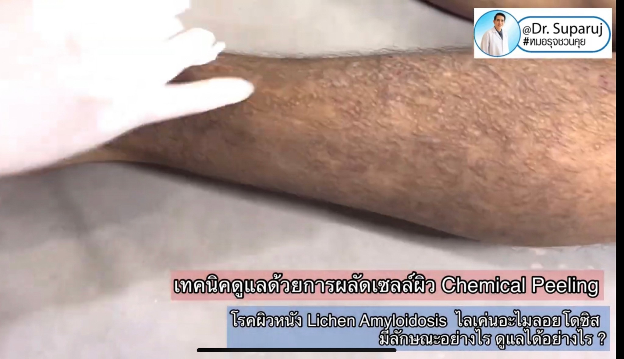 แนะนำการดูแลปัญหาโรคผิวหนัง: โรค Lichen amyloidosis ไลเค่น อะไมลอยโดซิส มีลักษณะอย่างไร ดูแลได้อย่างไร ?