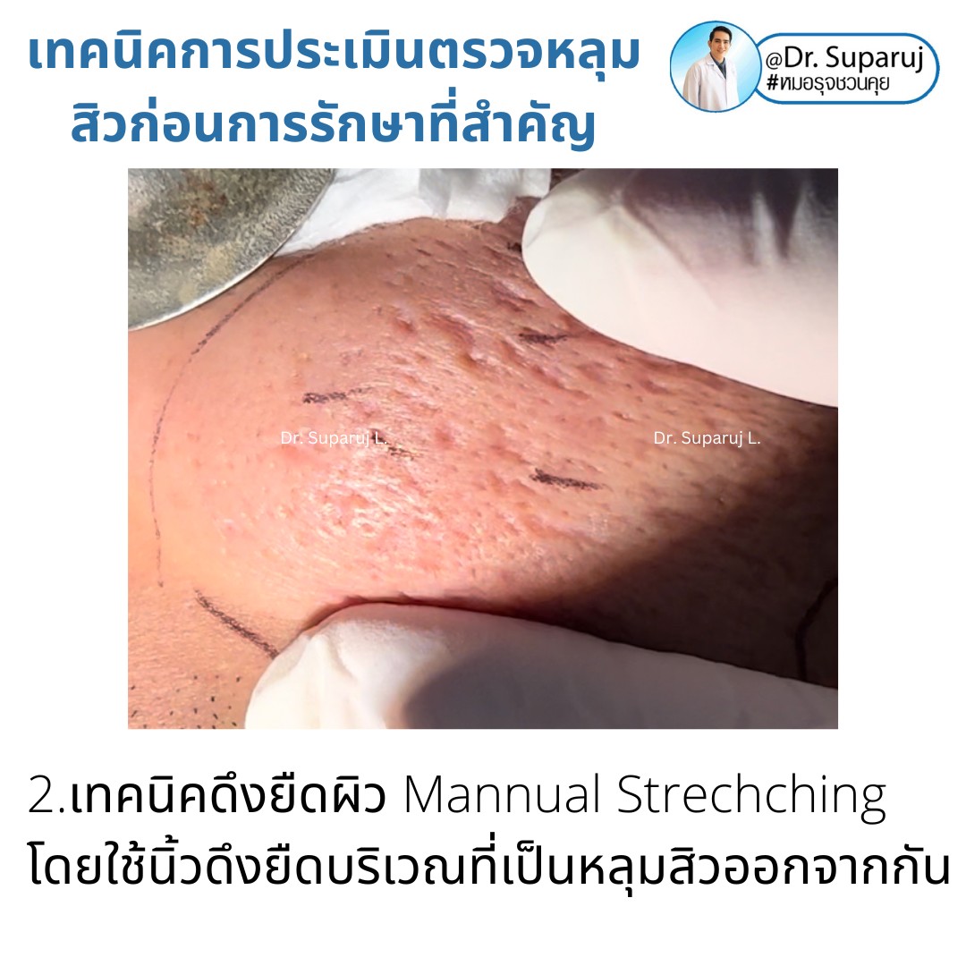 เทคนิคการประเมินตรวจหลุมสิวก่อนการรักษา Acne Scar Evaluation & Assessment เทคนิคการประเมินตรวจหลุมสิวก่อนการรักษา Acne Scar Evaluation & Assessment