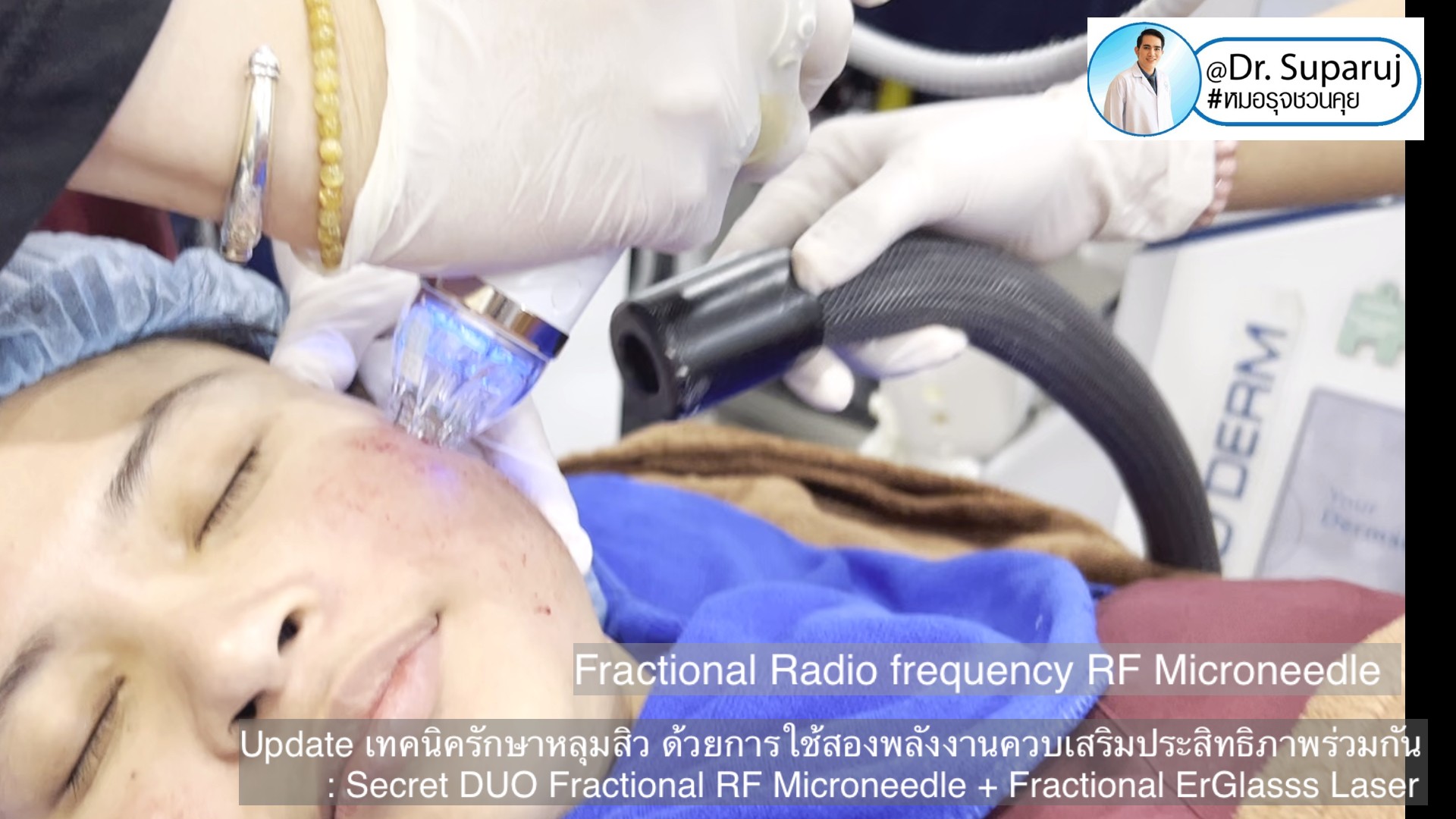 Update เทคนิครักษาหลุมสิว ด้วยการใช้สองพลังงานเสริมประสิทธิภาพร่วมกัน: Secret DUO Fractional RF Microneedle + Fractional ErGlasss Laser Update เทคนิครักษาหลุมสิว ด้วยการใช้สองพลังงานเสริมประสิทธิภาพร่วมกัน: Secret DUO Fractional RF Microneedle + Fractional ErGlasss Laser