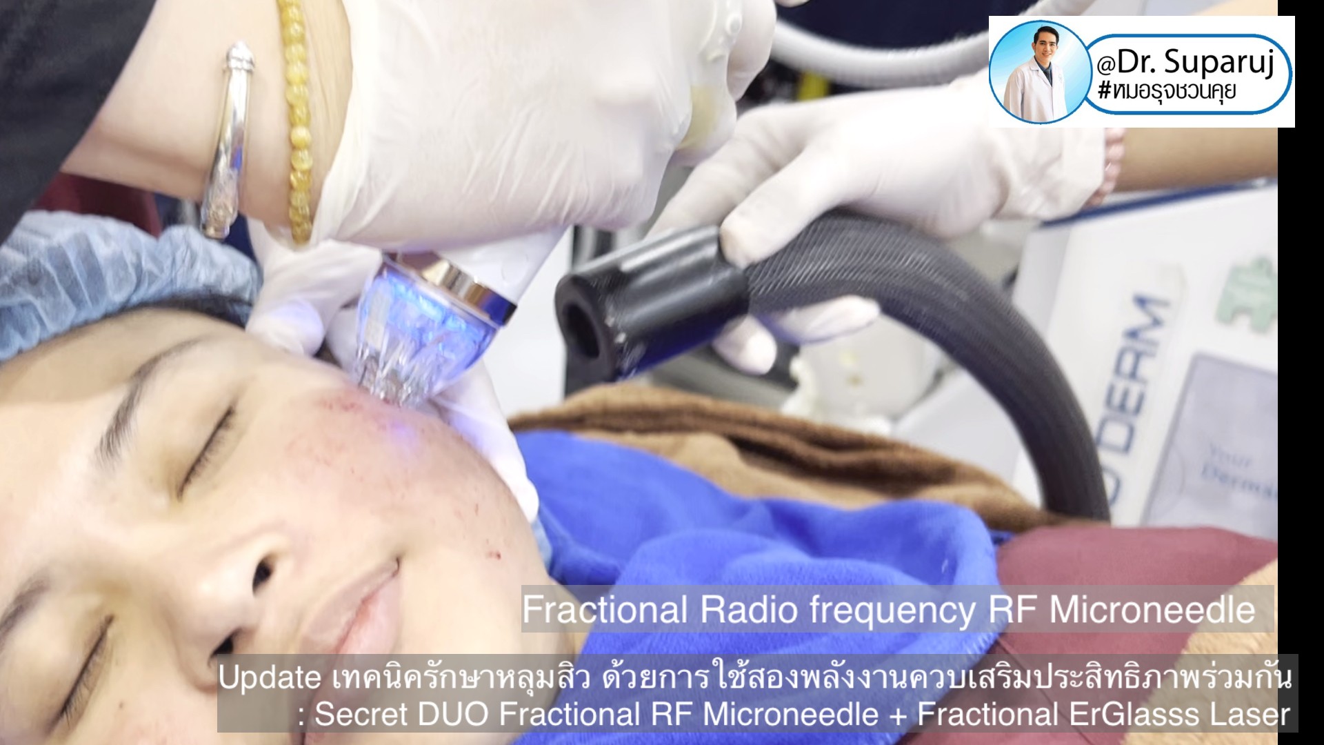 Update เทคนิครักษาหลุมสิว ด้วยการใช้สองพลังงานเสริมประสิทธิภาพร่วมกัน: Secret DUO Fractional RF Microneedle + Fractional ErGlasss Laser