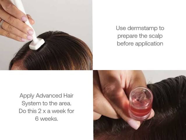 Update จากการประชุมแพทย์ผิวหนังระดับโลก WCD 2023: นวัตกรรมในการดูแลผมร่วงผมบางด้วยการใช้ Calecim Advanced Hair System Update จากการประชุมแพทย์ผิวหนังระดับโลก WCD 2023: นวัตกรรมในการดูแลผมร่วงผมบางด้วยการใช้ Calecim Advanced Hair System