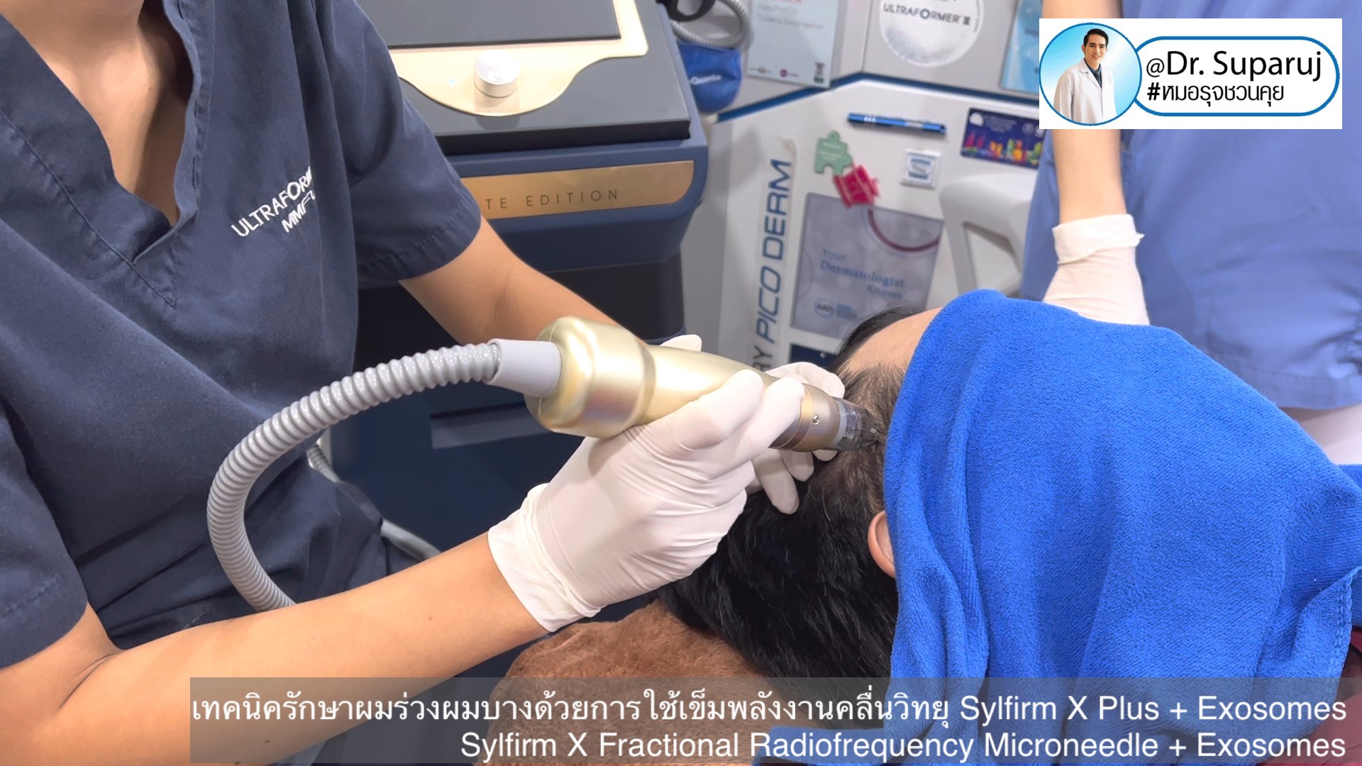 แนะนำ เทคนิครักษาผมร่วงผมบางด้วยการใช้เข็มพลังงานคลื่นวิทยุ Sylfirm X Plus + Exosomes (Sylfirm X Fractional Radiofrequency Microneedle + Exosomes) แนะนำ เทคนิครักษาผมร่วงผมบางด้วยการใช้เข็มพลังงานคลื่นวิทยุ Sylfirm X Plus + Exosomes (Sylfirm X Fractional Radiofrequency Microneedle + Exosomes)