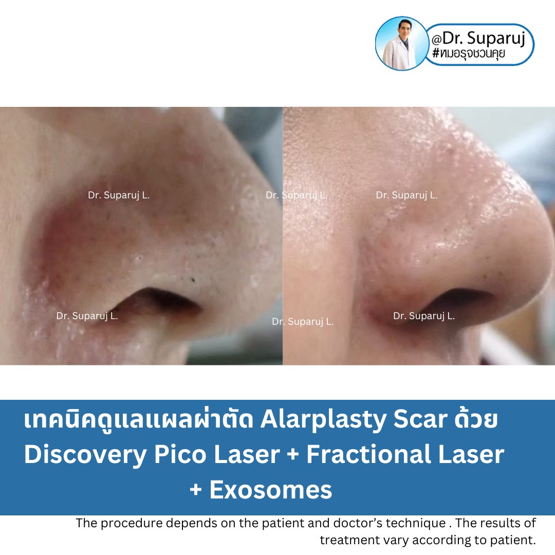 แนะนำเทคนิคดูแลแผลเป็นนูนคีลอยด์: รักษาแผลเป็นนูนด้วยทิกเซลล์ Tixel Fractional ThermoMechanical Ablation Devices + Exosomes แนะนำเทคนิคดูแลแผลเป็นนูนคีลอยด์: รักษาแผลเป็นนูนด้วยทิกเซลล์ Tixel Fractional ThermoMechanical Ablation Devices + Exosomes