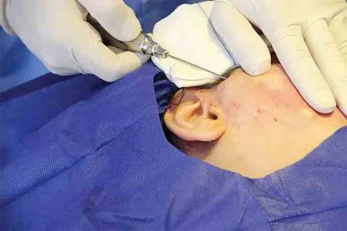 Update รักษาหลุมสิวด้วยเทคนิคการตัดพังผืด Blunt Blade Subcision (Blunt Blade Subcision for Acne Scar Fibrosis Treatment) Update รักษาหลุมสิวด้วยเทคนิคการตัดพังผืด Blunt Blade Subcision (Blunt Blade Subcision for Acne Scar Fibrosis Treatment)