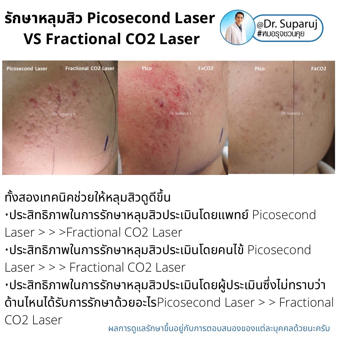 Update ผลการรักษาหลุมสิวด้วยเลเซอร์ Picosecond Laser VS Fractional CO2 Laser ต่างกันอย่างไร? เลเซอร์ชนิดไหนให้ผลดีกว่า?