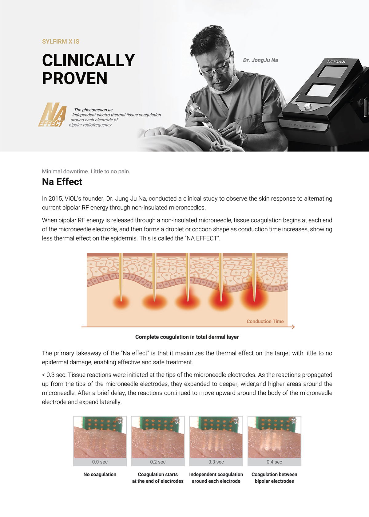 เทคนิครักษาหลุมสิวด้วย SYLFIRM X Plus Fractional RF Microneedle: มีลักษณะพลังงานพิเศษ Pulsed Wave PW Mode + Continous Wave CW Mode เทคนิครักษาหลุมสิวด้วย SYLFIRM X Plus Fractional RF Microneedle: มีลักษณะพลังงานพิเศษ Pulsed Wave PW Mode + Continous Wave CW Mode