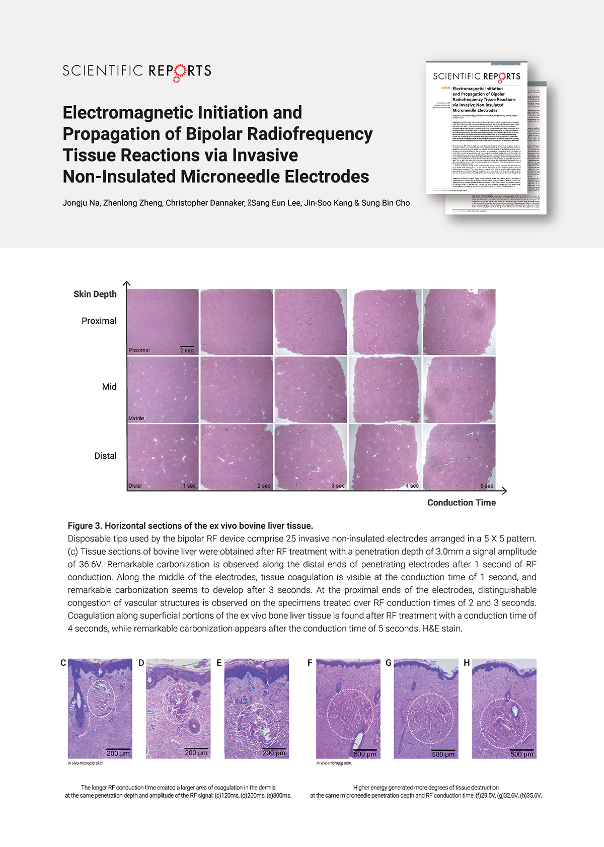 เทคนิครักษาหลุมสิวด้วย SYLFIRM X Plus Fractional RF Microneedle: มีลักษณะพลังงานพิเศษ Pulsed Wave PW Mode + Continous Wave CW Mode เทคนิครักษาหลุมสิวด้วย SYLFIRM X Plus Fractional RF Microneedle: มีลักษณะพลังงานพิเศษ Pulsed Wave PW Mode + Continous Wave CW Mode