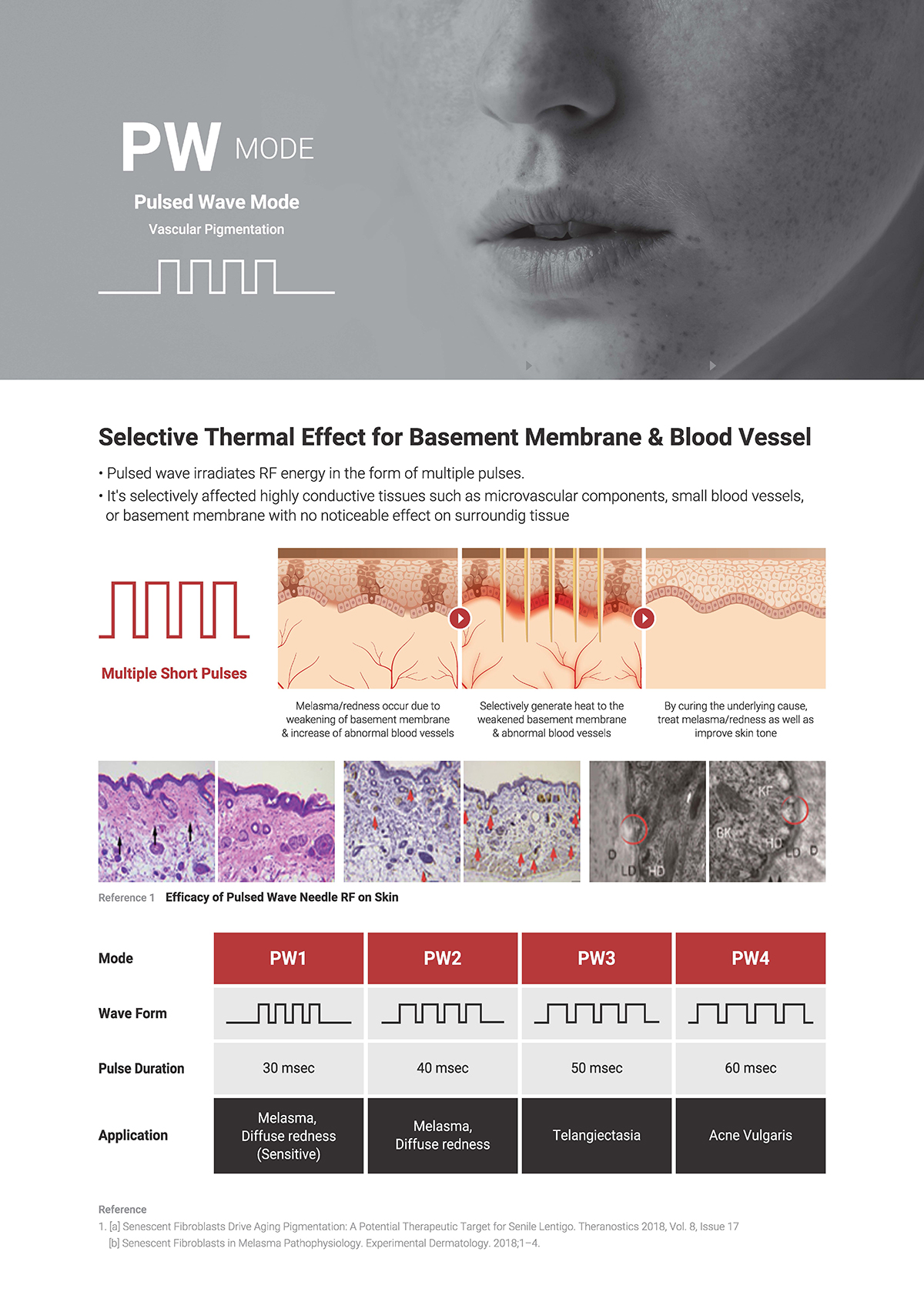 เทคนิครักษาหลุมสิวด้วย SYLFIRM X Plus Fractional RF Microneedle: มีลักษณะพลังงานพิเศษ Pulsed Wave PW Mode + Continous Wave CW Mode เทคนิครักษาหลุมสิวด้วย SYLFIRM X Plus Fractional RF Microneedle: มีลักษณะพลังงานพิเศษ Pulsed Wave PW Mode + Continous Wave CW Mode