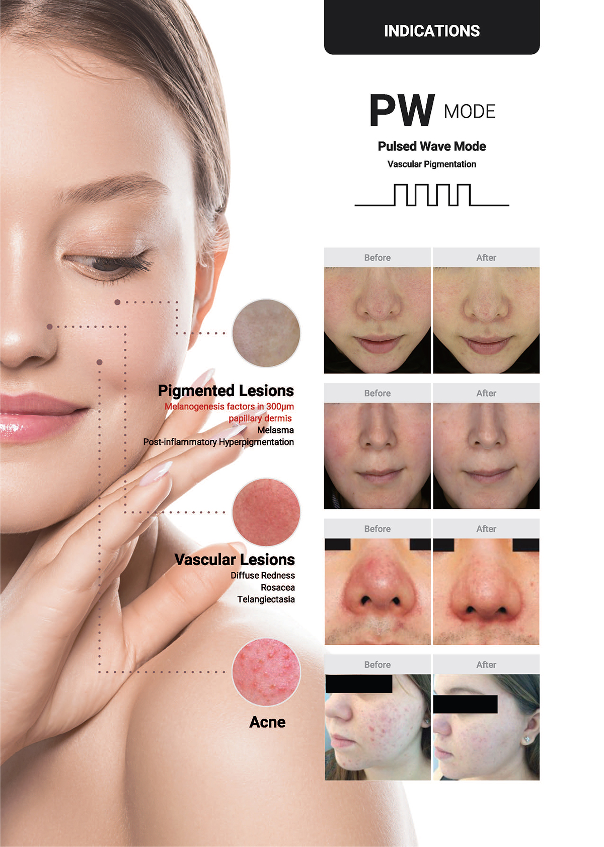 เทคนิครักษาหลุมสิวด้วย SYLFIRM X Plus Fractional RF Microneedle: มีลักษณะพลังงานพิเศษ Pulsed Wave PW Mode + Continous Wave CW Mode เทคนิครักษาหลุมสิวด้วย SYLFIRM X Plus Fractional RF Microneedle: มีลักษณะพลังงานพิเศษ Pulsed Wave PW Mode + Continous Wave CW Mode