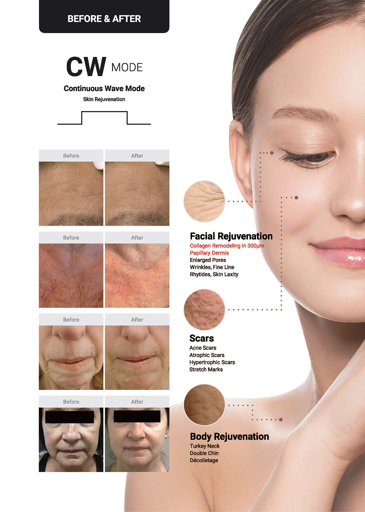 เทคนิครักษาหลุมสิวด้วย SYLFIRM X Plus Fractional RF Microneedle: มีลักษณะพลังงานพิเศษ Pulsed Wave PW Mode + Continous Wave CW Mode เทคนิครักษาหลุมสิวด้วย SYLFIRM X Plus Fractional RF Microneedle: มีลักษณะพลังงานพิเศษ Pulsed Wave PW Mode + Continous Wave CW Mode