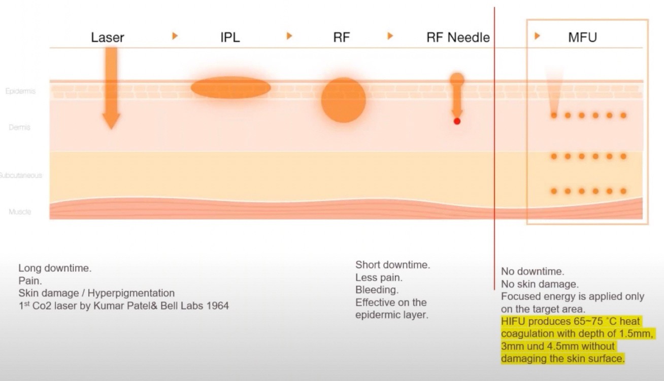 แนะนำเทคนิคยกกระชับใบหน้า: วิเคราะห์ผิว +ยกกระชับด้วย Ultraformer III ( Facial Analysis and Ultraformer III for Facial Tightening & Lifting) แนะนำเทคนิคยกกระชับใบหน้า: วิเคราะห์ผิว +ยกกระชับด้วย Ultraformer III ( Facial Analysis and Ultraformer III for Facial Tightening & Lifting)