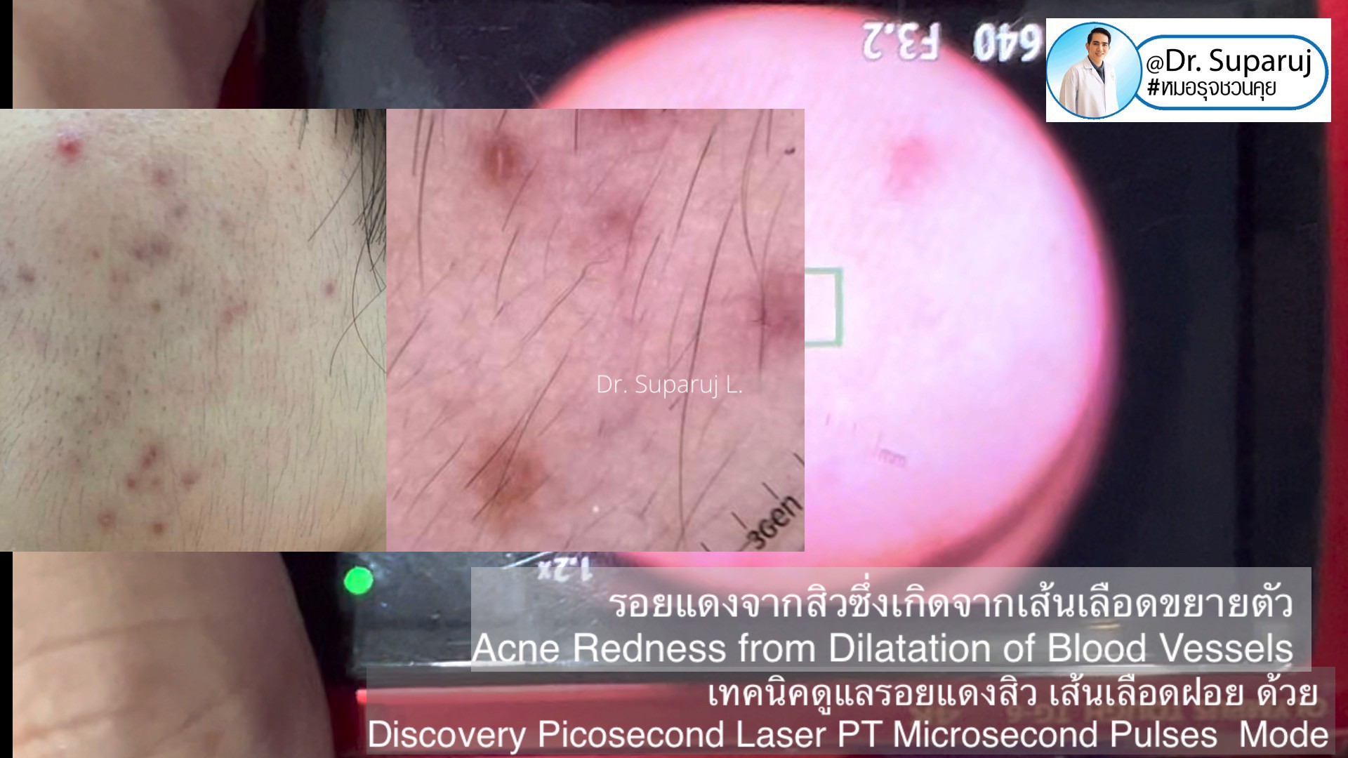 แชร์ประสบการณ์ Discovery Pico Laser พลีชีพความจริง แชร์ประสบการณ์ Discovery Pico Laser พลีชีพความจริง