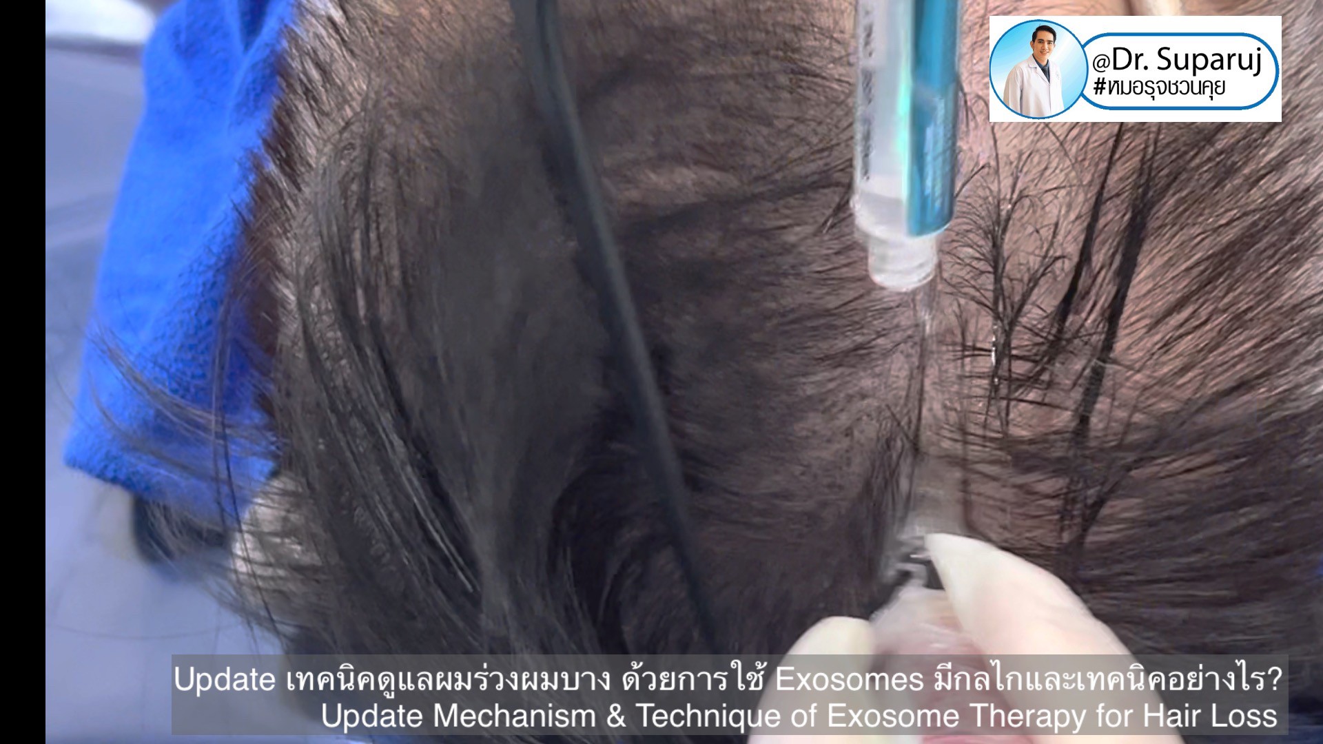 Update เทคนิค (เสริม)ดูแลผมร่วงผมบางจากพันธุกรรม AGA Update เทคนิค (เสริม)ดูแลผมร่วงผมบางจากพันธุกรรม AGA