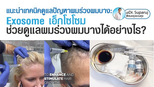 แนะนำเทคนิคดูแลปัญหาผมร่วงผมบาง: ASCE+™ HRLV Exosome เอเอสซีอีเอ็กโซโซม ช่วยดูแลผมร่วงผมบางได้อย่างไร? (ASCE+™ HRLV Exosome Therapy for Hair Loss) แนะนำเทคนิคดูแลปัญหาผมร่วงผมบาง: ASCE+™ HRLV Exosome เอเอสซีอีเอ็กโซโซม ช่วยดูแลผมร่วงผมบางได้อย่างไร? (ASCE+™ HRLV Exosome Therapy for Hair Loss)