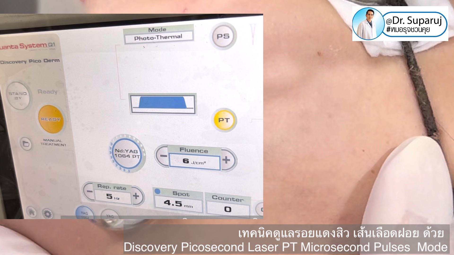 แชร์ประสบการณ์ Discovery Pico Laser พลีชีพความจริง แชร์ประสบการณ์ Discovery Pico Laser พลีชีพความจริง