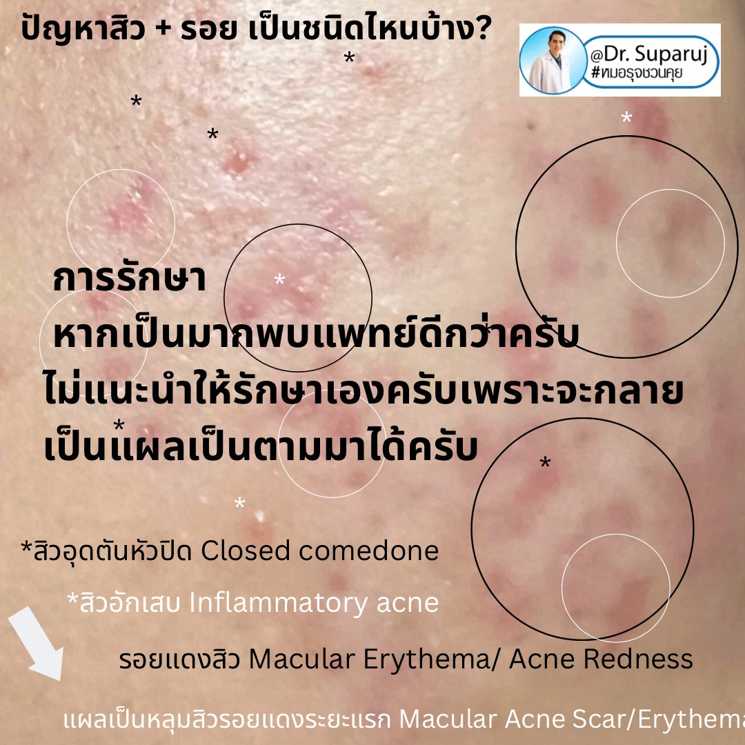 ปัญหาสิว + รอย เป็นชนิดไหนบ้าง? ปัญหาสิว + รอย เป็นชนิดไหนบ้าง?