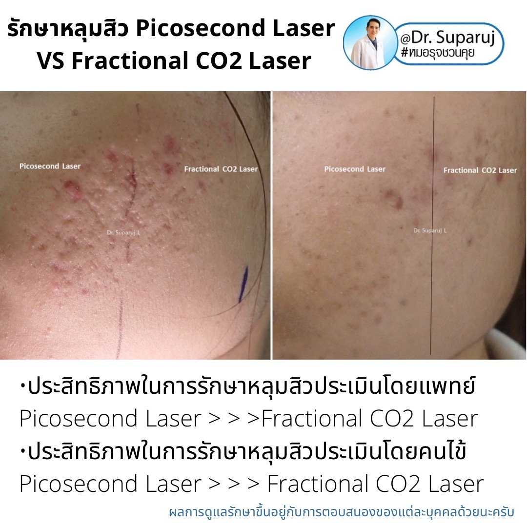 Update ผลการรักษาหลุมสิวด้วยเลเซอร์ Picosecond Laser VS Fractional CO2 Laser ต่างกันอย่างไร? เลเซอร์ชนิดไหนให้ผลดีกว่า?