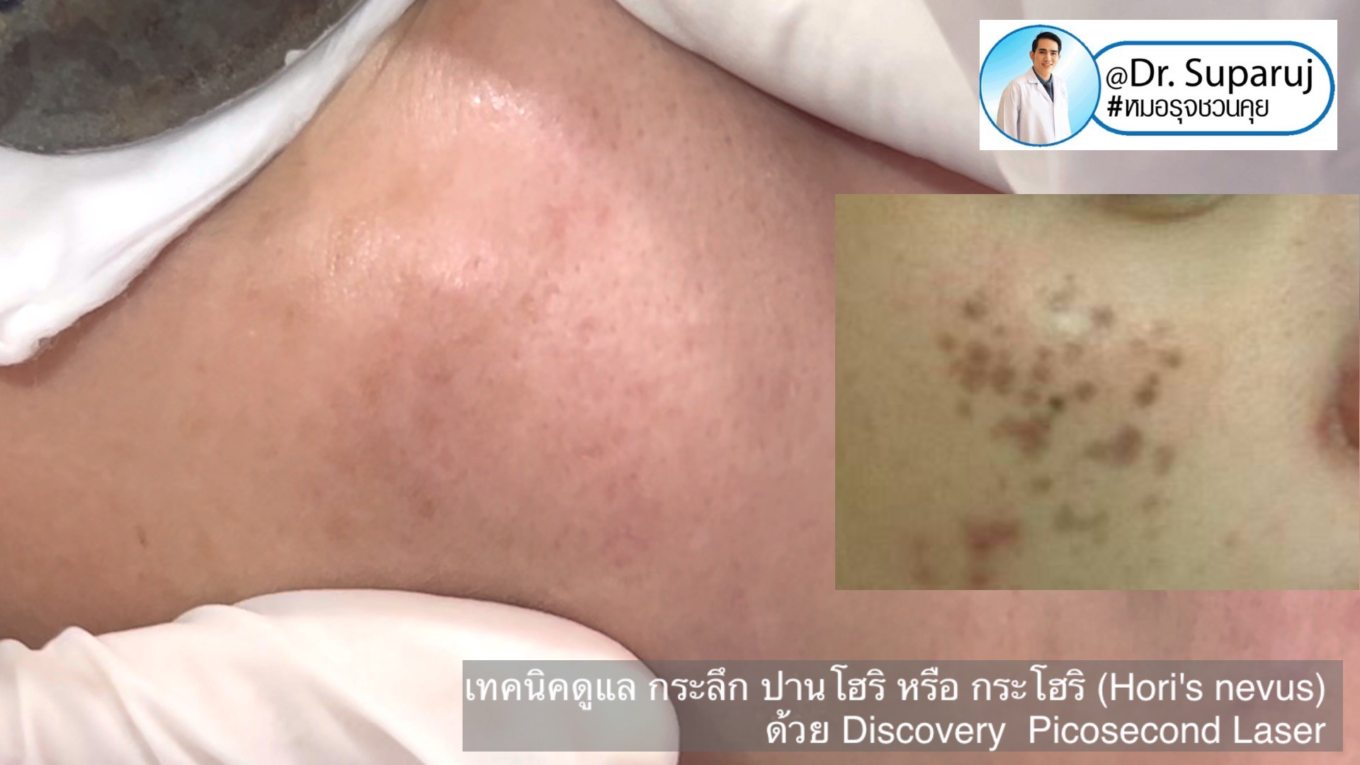 เทคนิครักษากระโฮริ กระลึก ปานโฮริ (Hori's nevus) ด้วยเลเซอร์ Discovery Picosecond Laser