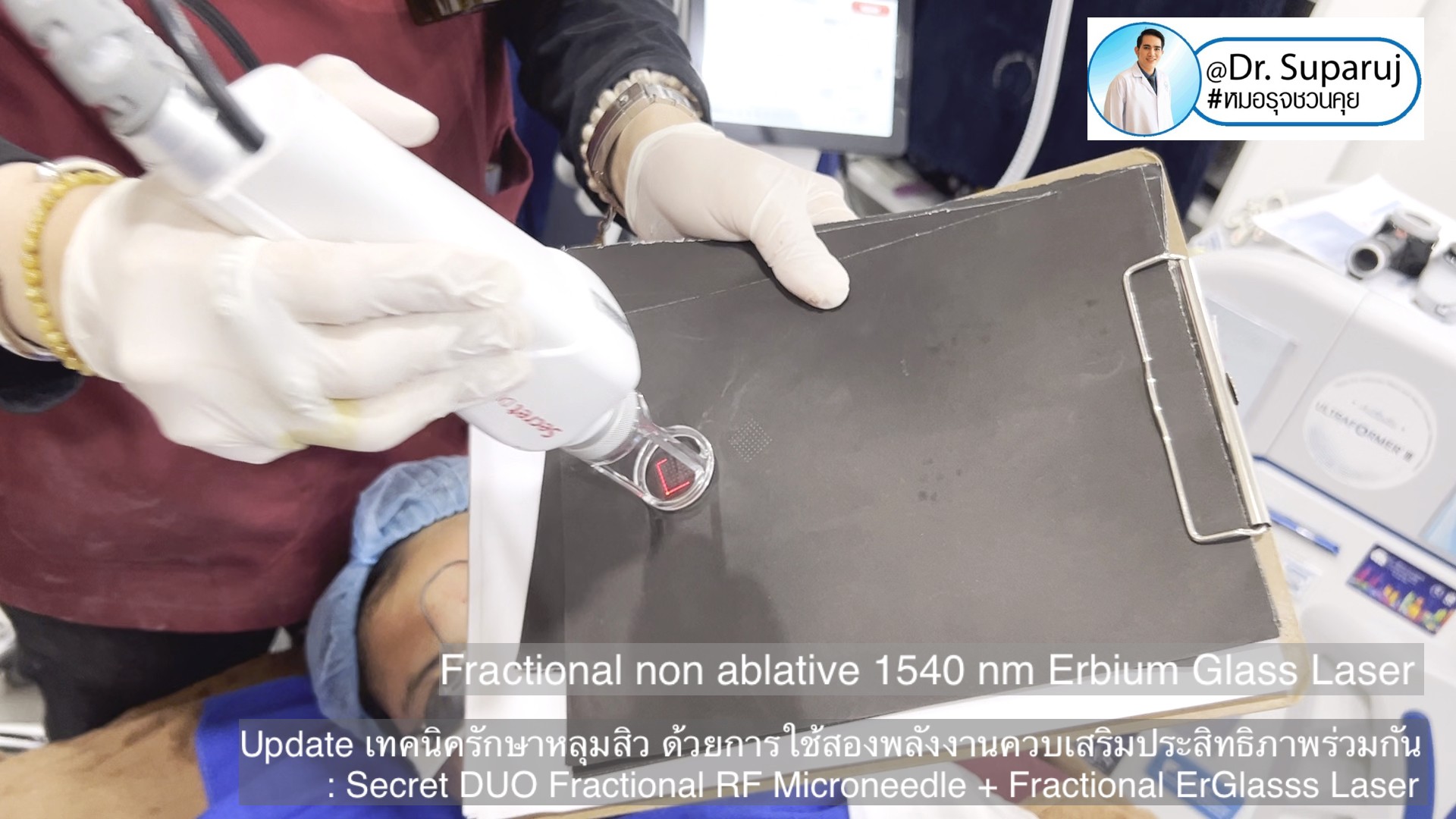Update เทคนิครักษาหลุมสิว ด้วยการใช้สองพลังงานเสริมประสิทธิภาพร่วมกัน: Secret DUO Fractional RF Microneedle + Fractional ErGlasss Laser Update เทคนิครักษาหลุมสิว ด้วยการใช้สองพลังงานเสริมประสิทธิภาพร่วมกัน: Secret DUO Fractional RF Microneedle + Fractional ErGlasss Laser