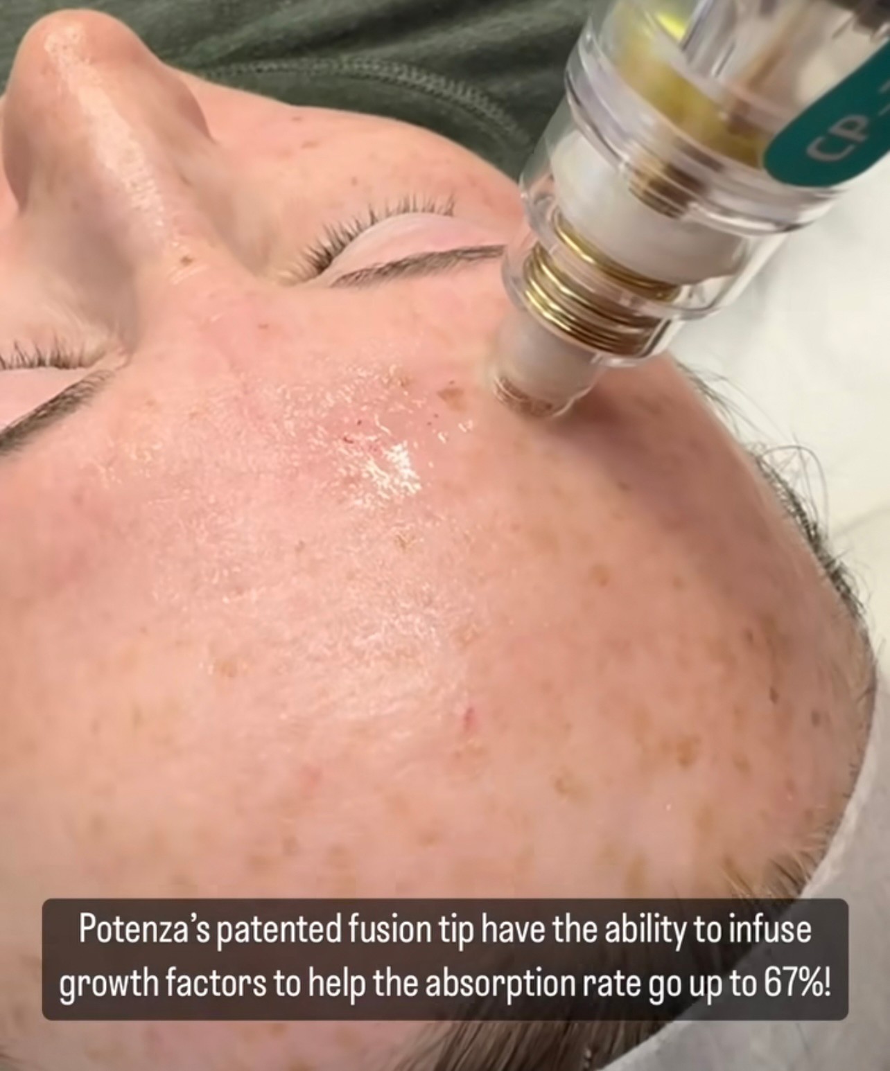 Update นวัตกรรมยกกระชับผิว ดูแลหลุมสิว ลดริ้วรอย: Potenza RF Microneedling โพเทนซ่า