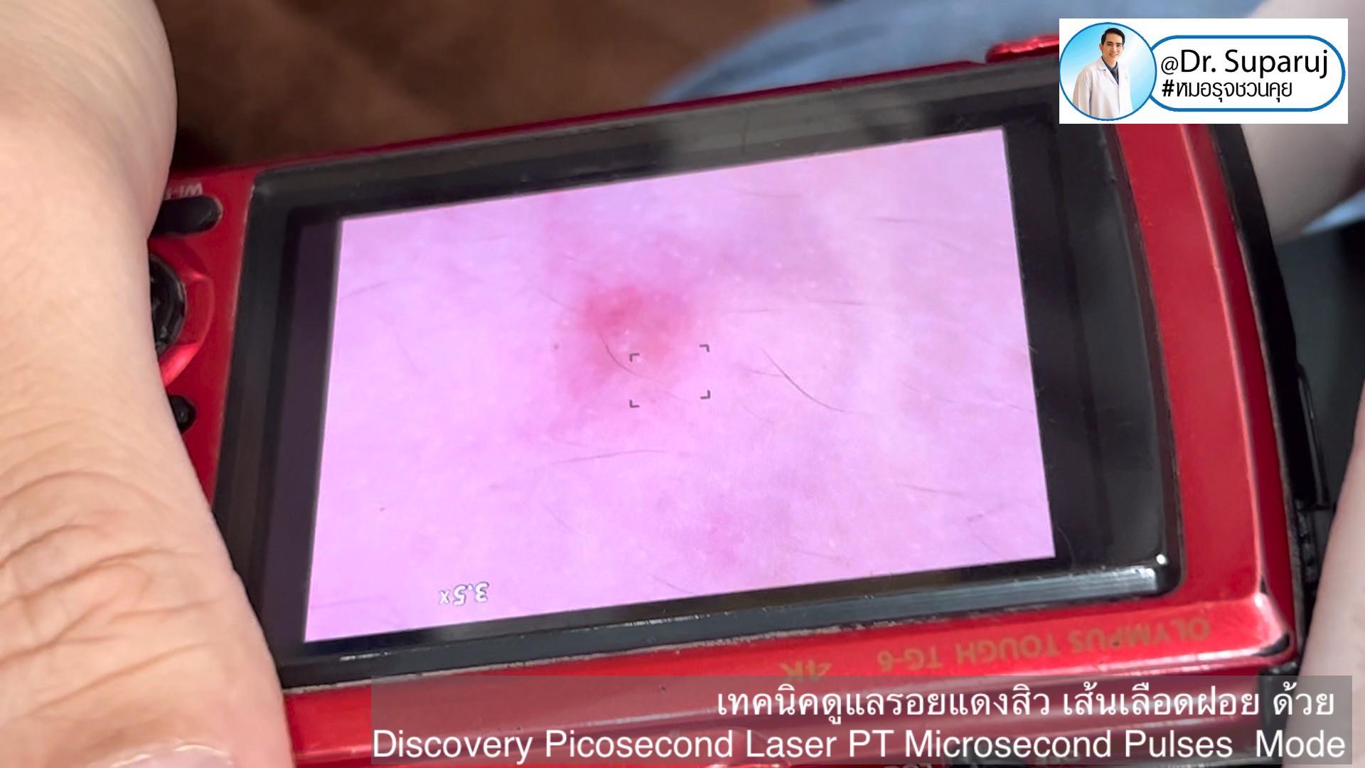 แชร์ประสบการณ์ Discovery Pico Laser พลีชีพความจริง