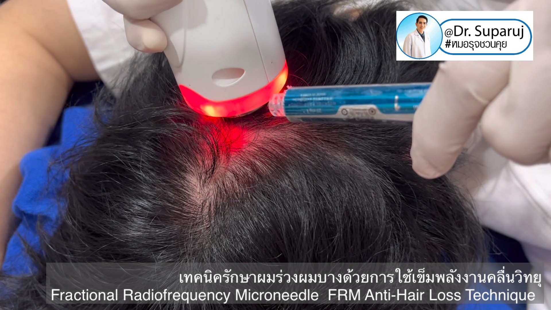 แนะนำเทคนิครักษาผมร่วงผมบาง: เทคนิครักษาผมร่วงผมบางด้วยการใช้เข็มพลังงานคลื่นวิทยุ Fractional Radiofrequency Microneedle FRM Anti-Hair Loss Technique แนะนำเทคนิครักษาผมร่วงผมบาง: เทคนิครักษาผมร่วงผมบางด้วยการใช้เข็มพลังงานคลื่นวิทยุ Fractional Radiofrequency Microneedle FRM Anti-Hair Loss Technique