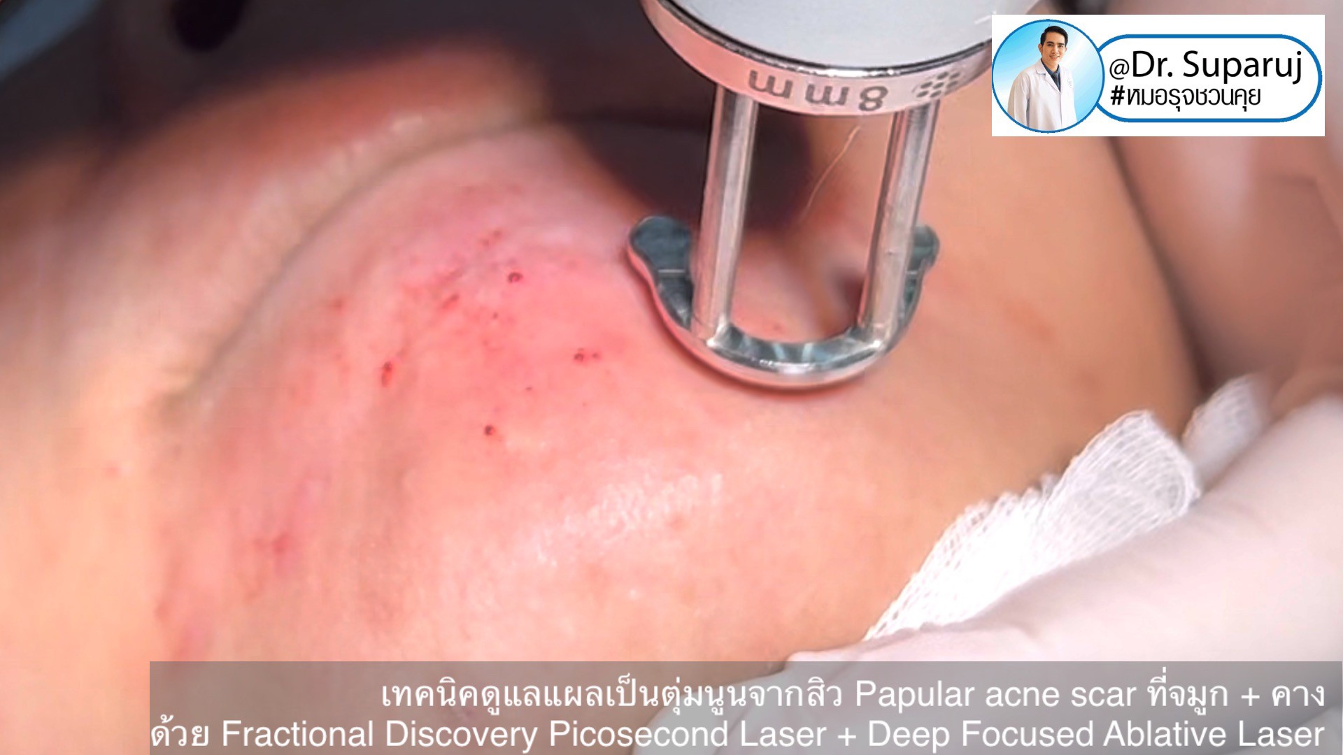 เทคนิคดูแลแผลเป็นตุ่มนูนจากสิว Papular acne scar ที่จมูก + คาง ด้วย Fractional Discovery Picosecond Laser + Deep Focused Ablative Laser เทคนิคดูแลแผลเป็นตุ่มนูนจากสิว Papular acne scar ที่จมูก + คาง ด้วย Fractional Discovery Picosecond Laser + Deep Focused Ablative Laser
