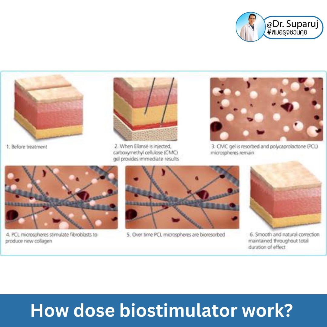 Update เทคนิคกระตุ้นการสร้างคอลลาเจนในผิวหนังลดเลือนริ้วรอย: Collagen Biostimulator Update เทคนิคกระตุ้นการสร้างคอลลาเจนในผิวหนังลดเลือนริ้วรอย: Collagen Biostimulator