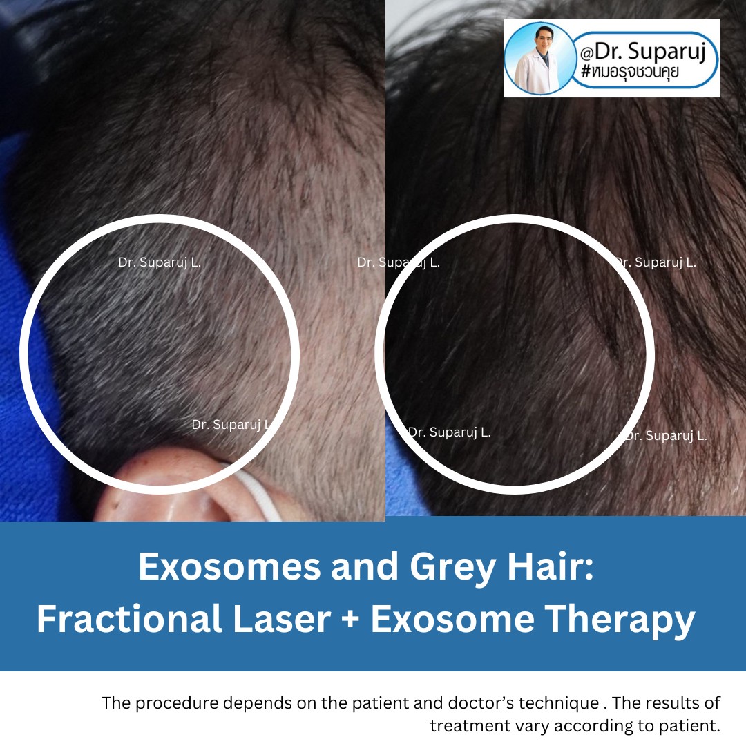 แนะนำเทคนิครักษาผมร่วงผมบาง: เทคนิครักษาผมร่วงผมบางด้วยการใช้เข็มพลังงานคลื่นวิทยุ Fractional Radiofrequency Microneedle FRM Anti-Hair Loss Technique แนะนำเทคนิครักษาผมร่วงผมบาง: เทคนิครักษาผมร่วงผมบางด้วยการใช้เข็มพลังงานคลื่นวิทยุ Fractional Radiofrequency Microneedle FRM Anti-Hair Loss Technique