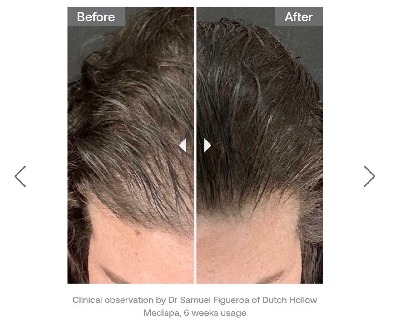 Update จากการประชุมแพทย์ผิวหนังระดับโลก WCD 2023: นวัตกรรมในการดูแลผมร่วงผมบางด้วยการใช้ Calecim Advanced Hair System Update จากการประชุมแพทย์ผิวหนังระดับโลก WCD 2023: นวัตกรรมในการดูแลผมร่วงผมบางด้วยการใช้ Calecim Advanced Hair System