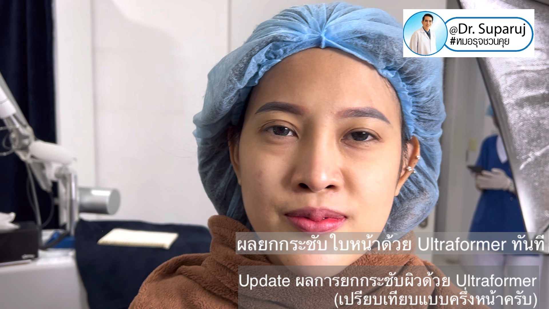 Update ผลการยกกระชับผิวด้วย Ultraformer III (เปรียบเทียบแบบครึ่งหน้าให้เห็นชัดๆครับ) Update ผลการยกกระชับผิวด้วย Ultraformer III (เปรียบเทียบแบบครึ่งหน้าให้เห็นชัดๆครับ)