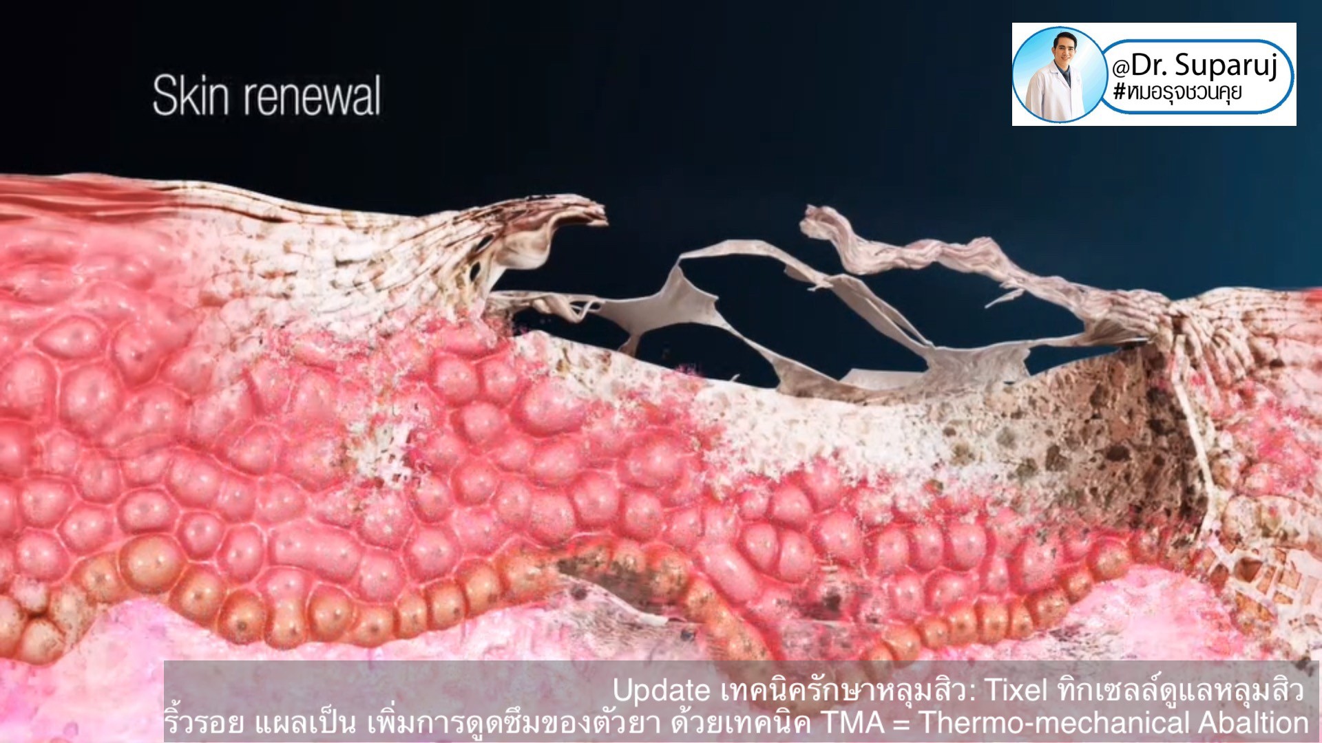 Update เทคนิครักษาหลุมสิว: Tixel ทิ๊กเซลล์ รักษาหลุมสิว ริ้วรอย แผลเป็น เพิ่มการดูดซึมยาด้วยเทคนิค TMA = Thermo-mechanical Abaltion Update เทคนิครักษาหลุมสิว: Tixel ทิ๊กเซลล์ รักษาหลุมสิว ริ้วรอย แผลเป็น เพิ่มการดูดซึมยาด้วยเทคนิค TMA = Thermo-mechanical Abaltion