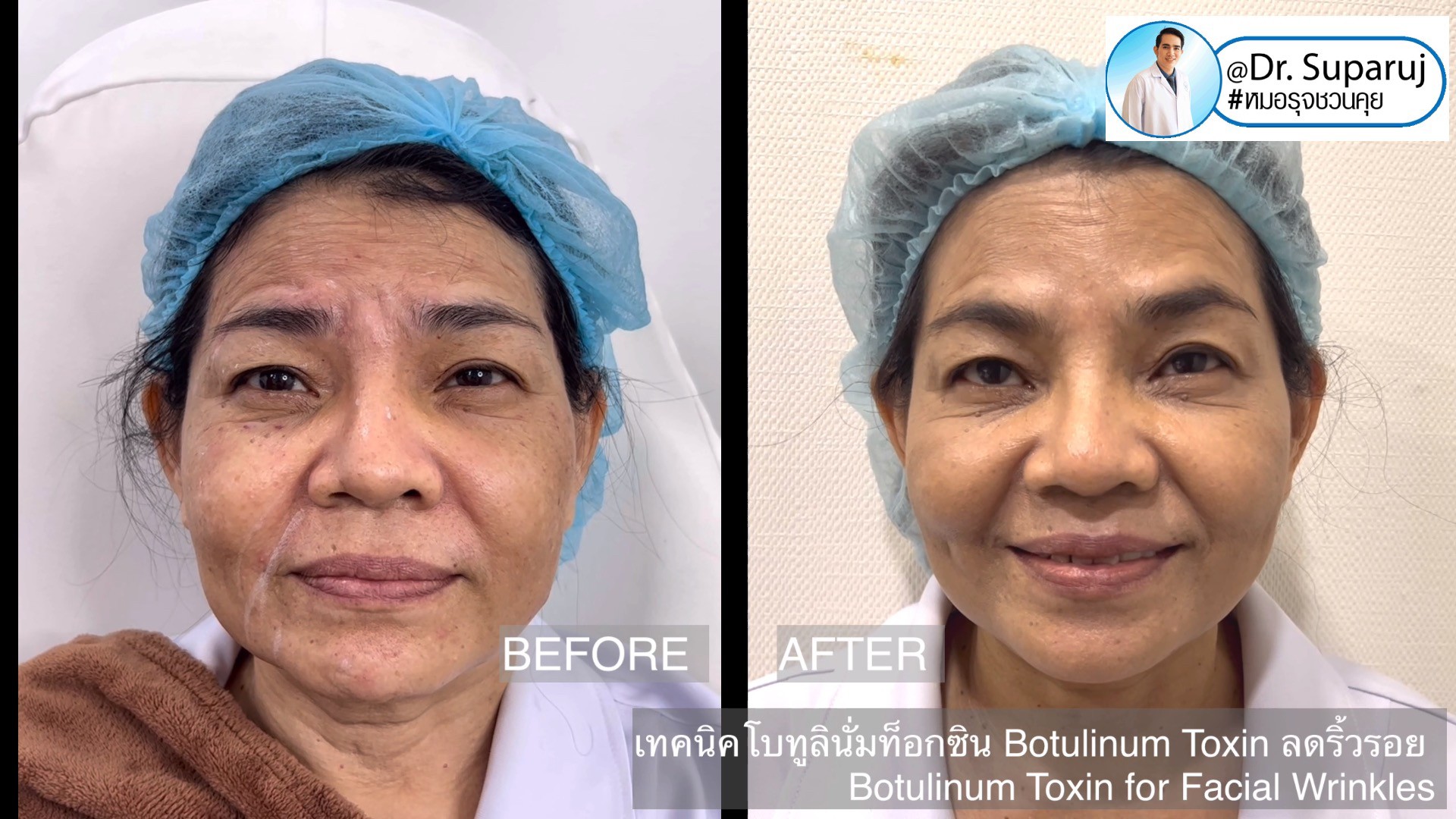 เทคนิคโบทูลินั่มท็อกซิน Botulinum Toxin ลดริ้วรอย Botulinum Toxin for Facial Wrinkles เทคนิคโบทูลินั่มท็อกซิน Botulinum Toxin ลดริ้วรอย Botulinum Toxin for Facial Wrinkles