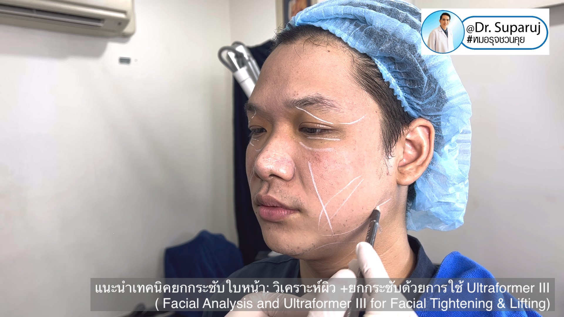 แนะนำเทคนิคยกกระชับใบหน้า: วิเคราะห์ผิว +ยกกระชับด้วย Ultraformer III ( Facial Analysis and Ultraformer III for Facial Tightening & Lifting) แนะนำเทคนิคยกกระชับใบหน้า: วิเคราะห์ผิว +ยกกระชับด้วย Ultraformer III ( Facial Analysis and Ultraformer III for Facial Tightening & Lifting)